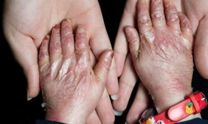 تجدید فراخوان تامین پانسمان‌های بیماران پروانه ای