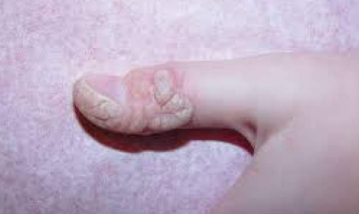 امید تازه در درمان HPV؛ اثربخشی ۴۶ درصدی داروی موضعی ABI-2280 در کارآزمایی بالینی