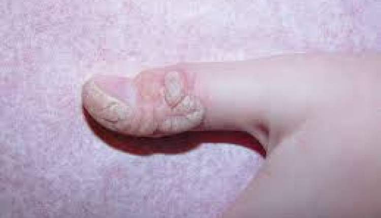 امید تازه در درمان HPV؛ اثربخشی ۴۶ درصدی داروی موضعی ABI-2280 در کارآزمایی بالینی